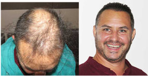 Transplante de pelo Biofibre Exoderm Alopecia 